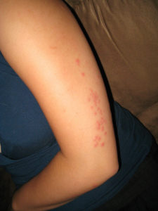 Bedbug bites